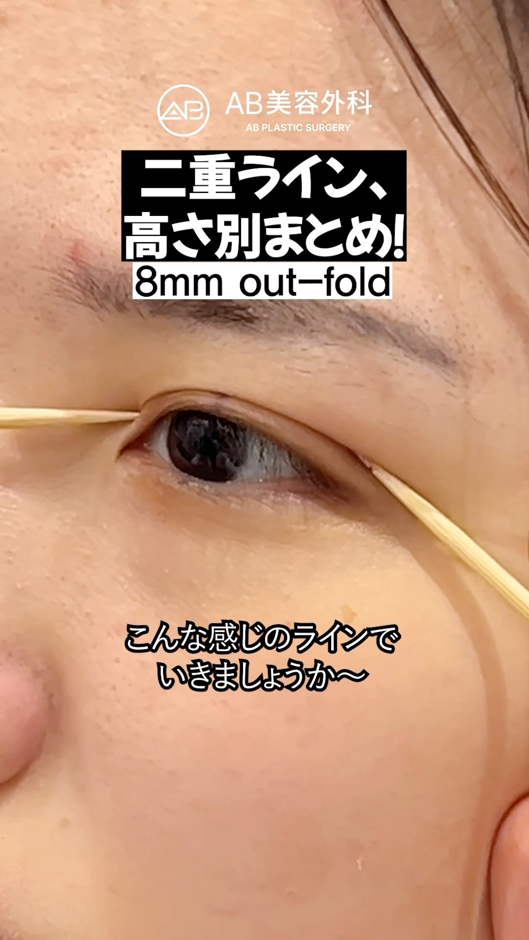 二重ラインの高さ比較！ | AB美容整形