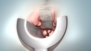 hemorrhoid removal (hemorrhoidectomy)