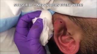 Infected Earlobe Drained Uncensored Infected Earlobe Drained Uncensored