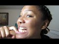 Invisalign update #7 | 2 years and 6 months later | Removing my attachments, more trays