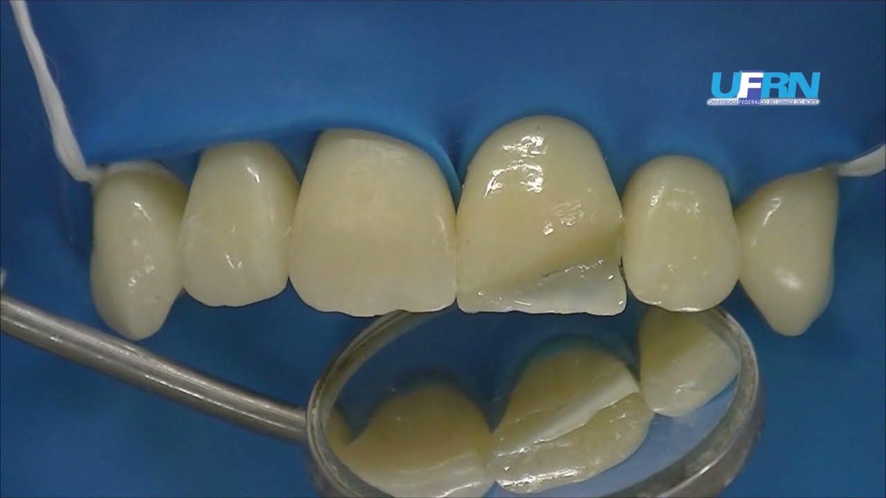 CLASSE IV  A MÃO LIVRE  Preparo Obliquo e Restauração