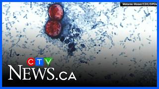 More than 1000 in the U.S. infected with food-born parasite