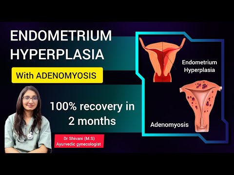 Endometrial hyperplasia with adenomyosis - case discussion ayurvedic treatment #ayurvedictreatment