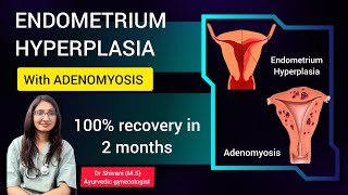 Endometrial Hyperplasia With Adenomyosis - Case Discussion Ayurvedic Treatment