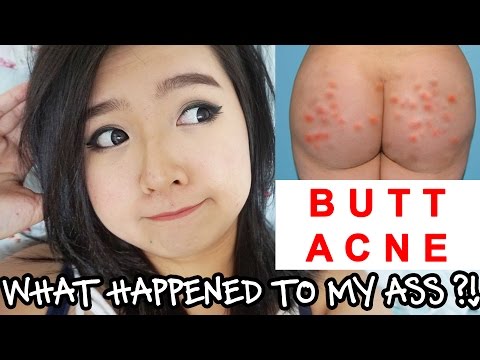 Guess i can never escape acne.. even on my butt.. ✈ vlog channel https://www./c/erainemokk ★ snapchat https://www.snapchat.com/add/erainemokk ♠ in...
