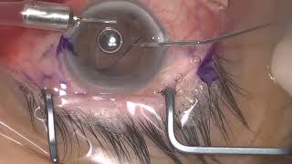 Retinal forceps for explantation of IOL