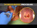 How Thyroid Biopsy procedure is performed?
