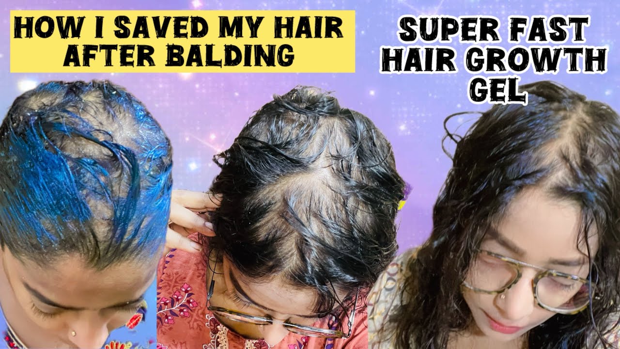 How I Saved My Hair After Balding🧑‍🦲Super Fast Hair Growth Gel👌