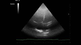 CASE 1106 ECHO PULMONARY EMBOLISM PE