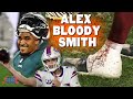 Alex Smith’s Bloody Leg, Worst 11-0 & Hurts to Start