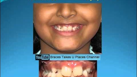 Early treatment with fixed braces at 9 yrs age for 6 months only for bugs bunny teeth