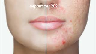 افضل علاج لحب الشباب ؟ how to get rid of acne ?