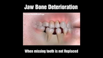 What happens when missing tooth is not replaced?