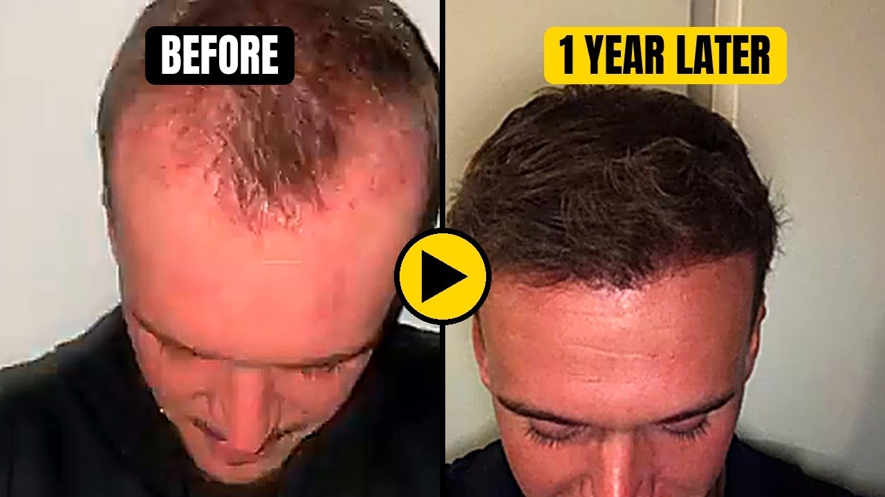 Repackaging Concept – World Nomac: Hair Transplant 1 Year Later (2 thumbnails)