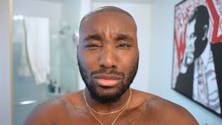 My Hairline Surgery WENT COMPLETELY WRONG...