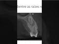 Caninos inclusos na maxila #cirurgiabucomaxilofacial #bucomaxilo #dentista