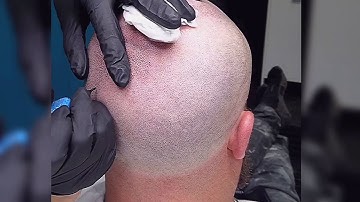 Time lapse video- Male Scalp Micro Pigmentation Treatment from start to finish by Caitlin James