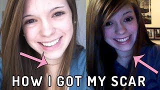 My Hypothyroidism and Surgery Story | Vlogmas 12/8/19 | SoundProofLiz