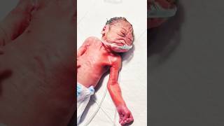 New born baby medical issue with nucu admid #trending #cutebaby #shortvideo #adoreble #shorts