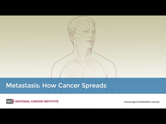 Metastasis: How Cancer Spreads class=