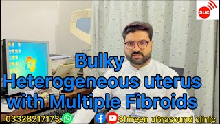Bulky Heterogeneous With Multiple Fibroids