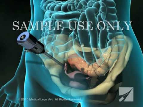 Diagnostic Pelvic Laparoscopy