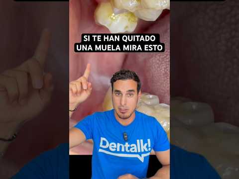 ¿Por qué te quieren quitar también la MUELA del JUICIO de arriba?