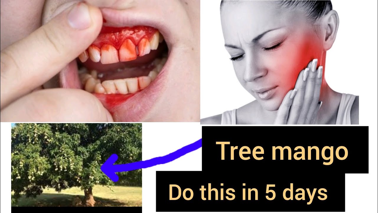 TREE OF MANGO ONLY FINISH YOUR PAIN 🦷🦷🦷 TEETH - YouTube