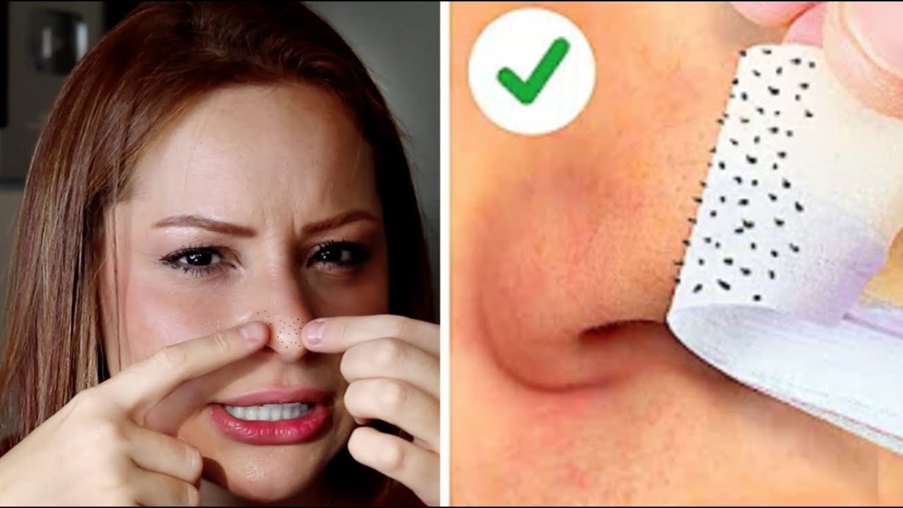 COMO REMOVER CRAVOS/ESPINHAS PARA SEMPRE - YouTube