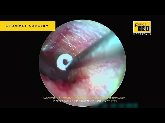 Myringotomy with grommet insertion