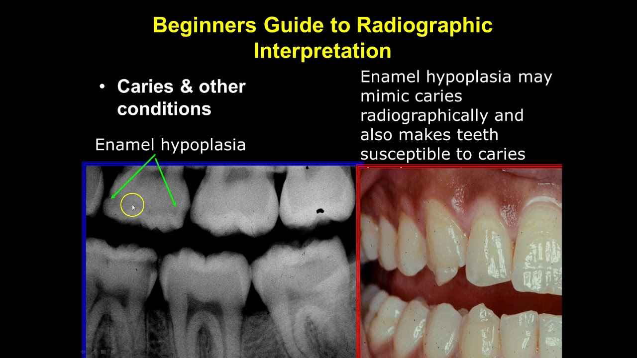Radiographic Interpretation Section 2 YouTube