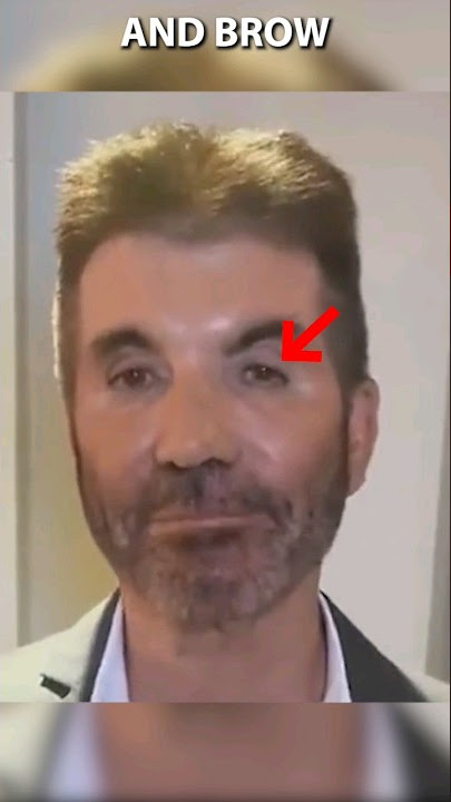 What Happened to Simon Cowell's Face?