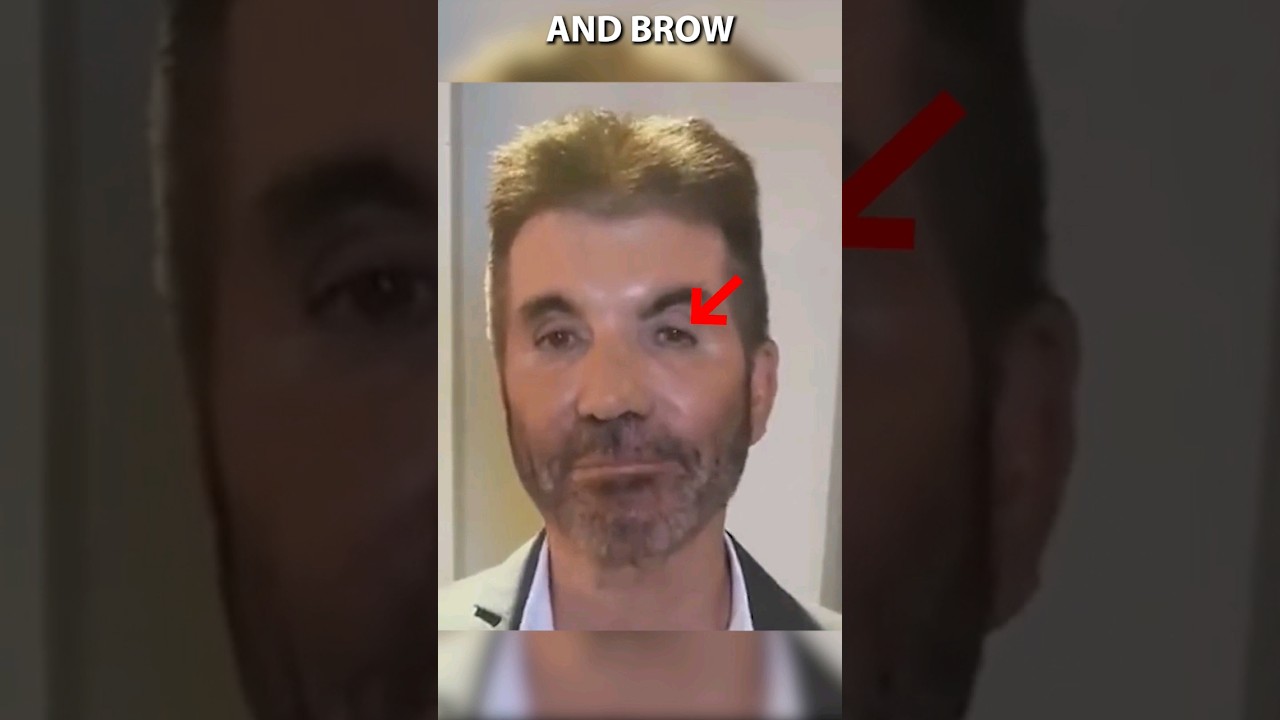 What Happened To Simon Cowell s Face YouTube What Happened To Simon Cowell s Face YouTube
