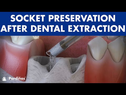 Tooth extraction - Treatment for socket preservation ©