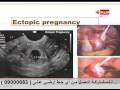 العيادة - د.إسماعيل أبو الفتوح - بالصور أشكال الإجهاض وكيف يحدث - The Clinic
