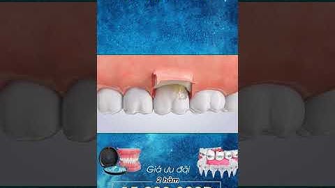 [3D] TRÁM LỖ RĂNG SÂU || Nha Khoa Quốc Tế Athena