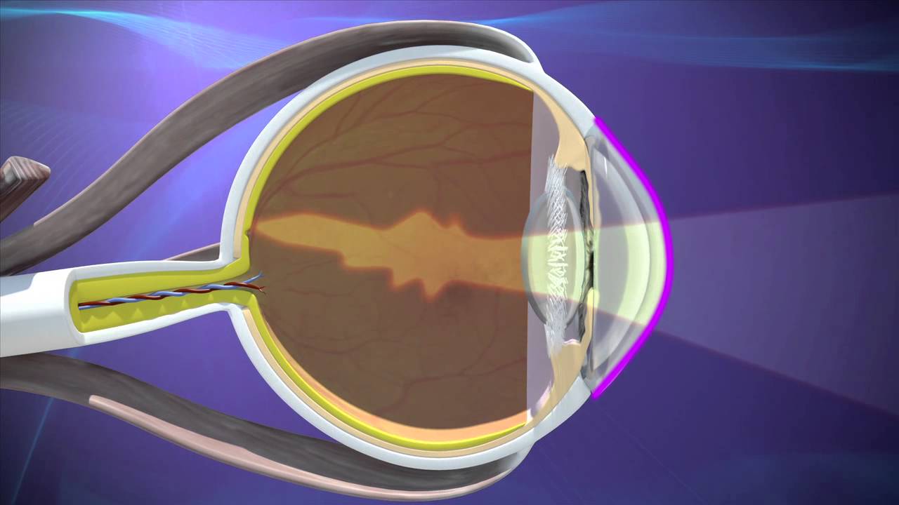 Astigmatism Treatment & Surgery Atlanta, GA. YouTube