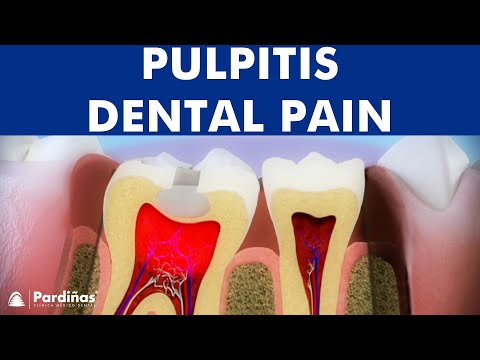 Pulpitis - Inflammation of tooth pulp ©
