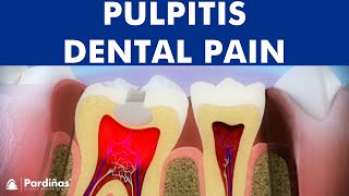 Pulpitis - Inflammation of tooth pulp ©