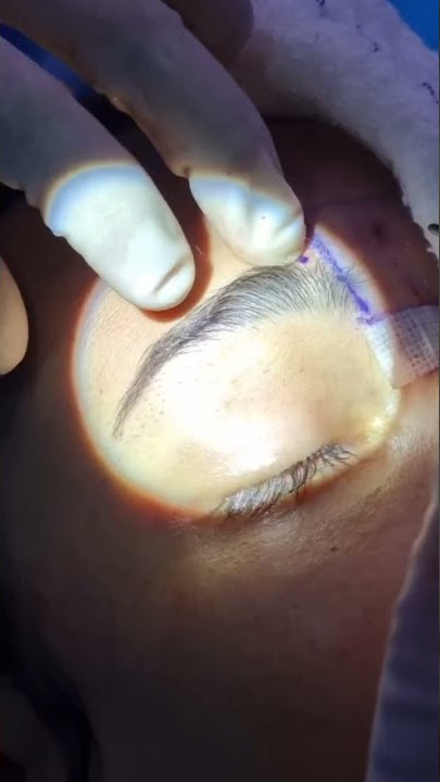 Transgender Surgery