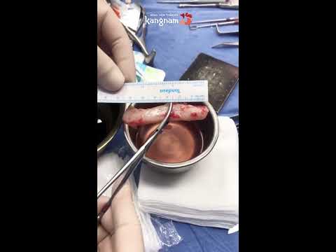 video quy trình nâng mũi