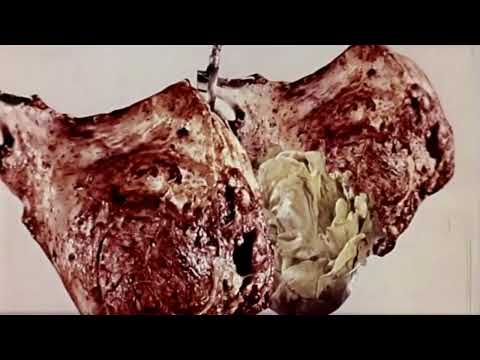 Video Sindrome di Stoccolma