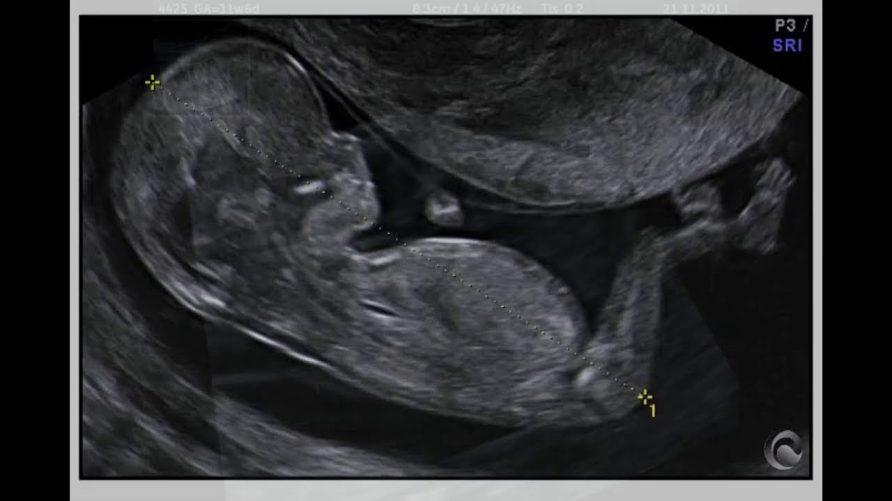 MEDICIÓN DE LA TRANSLUCENCIA NUCAL TRISOMÍA 21 CÓMO MEDIR LA TRANSLUCENCIA NUCAL