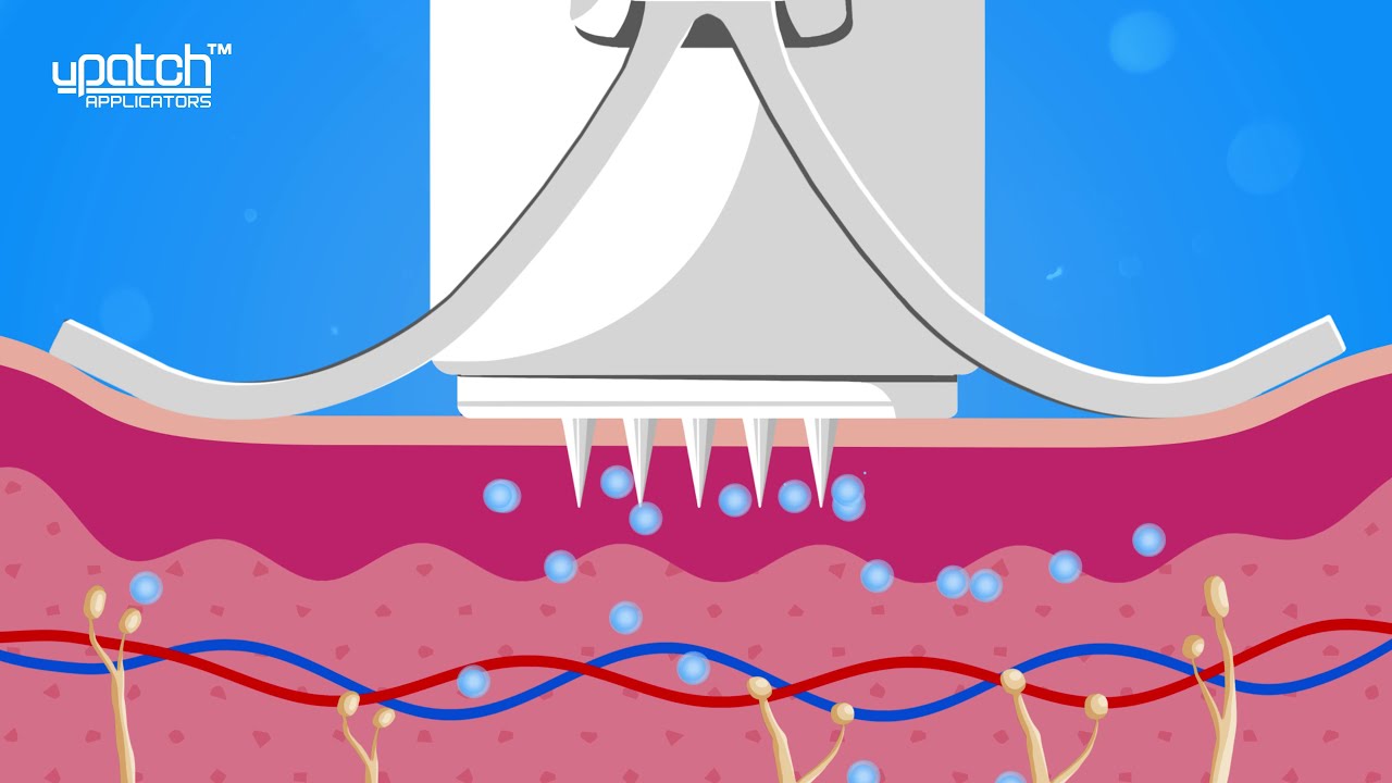 Why Hand-Pressed Microneedles Fail (and What Actually Works)