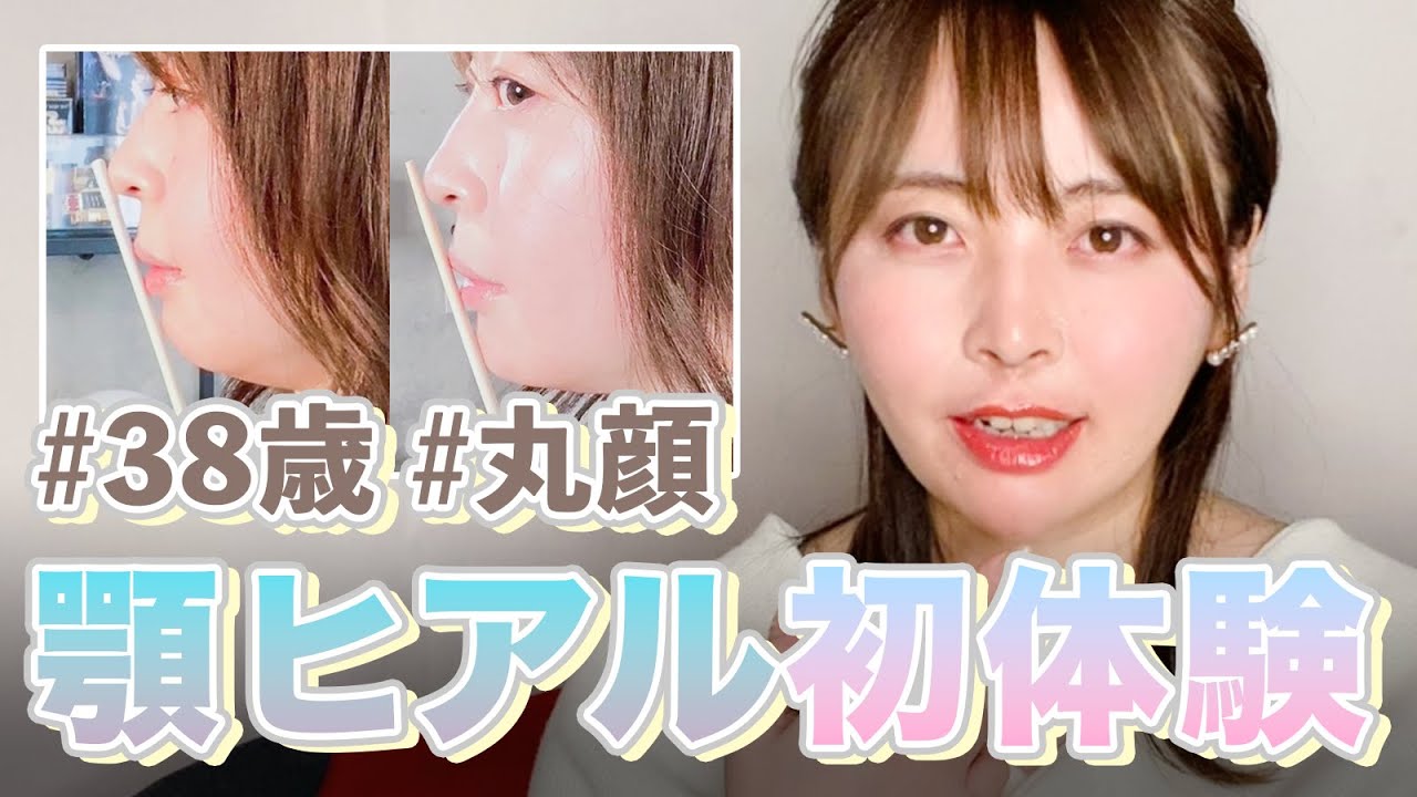 ビフォアフあり 丸顔アゴなし が顎にヒアルロン酸入れてみた Eラインできるか Youtube