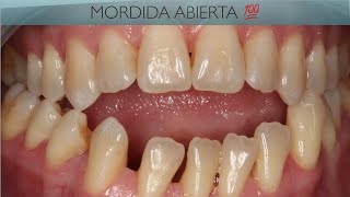 Mordida Abierta Esquelética Clase III Sin Cirugía. Skeletal Open bite Class III without surgery