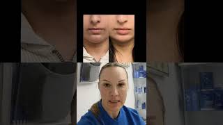 Celebrity How long does lip filler last? Profile