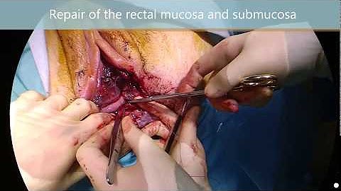 Anal Surgery