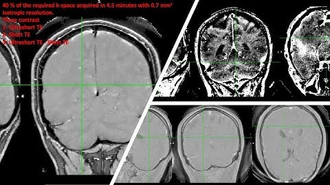A Journey from Single-Voxel to Whole Brain Noninvasive Molecular and Myelin Imaging