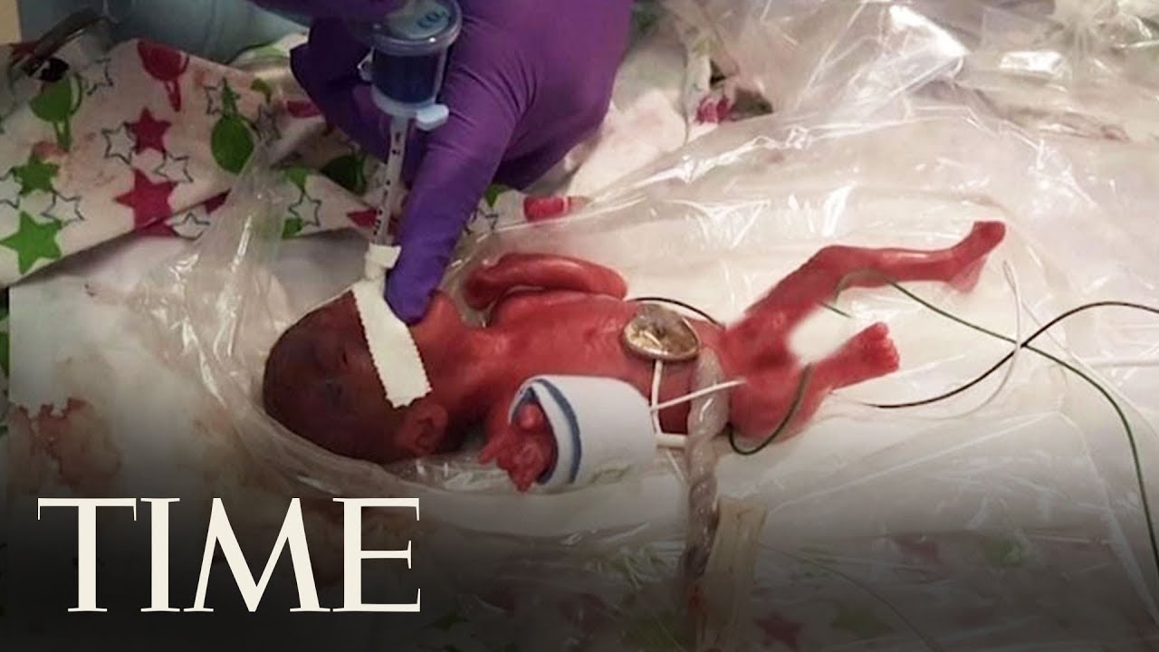 San Diego Hospital Reveals Birth Of World's Tiniest Surviving Baby | TIME